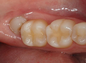 dente-do-siso-incluso-e-impactado